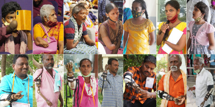 LN-4 Prosthetic Hands the US imported artificial functional hands worth INR 7 Crore distributed free to the poor and the needy